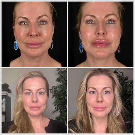 No makeup Holiday Glow Up progress:  Top Left: Before; Top Right: Immediately following filler and red light therapy; Bottom Left: 24 hours after filler and red light therapy; Bottom Right: Final Glow-Up After filler and salmon DNA facial